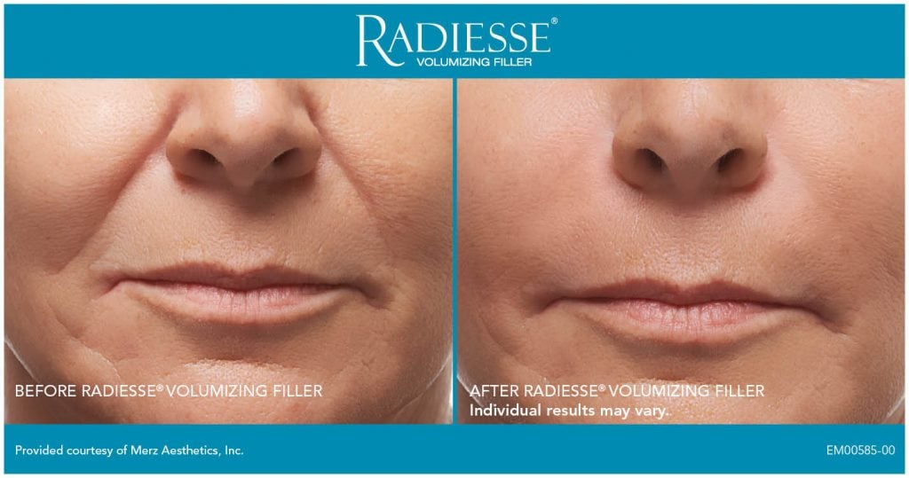Radiesse Before After